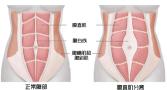 产后肚子隆起、皮肤松弛？可能是腹直肌分离！
