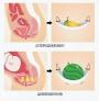 盆底肌修复，去医院or家用盆底肌修复仪，该怎么选择？