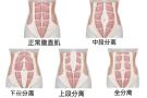 女生小肚子突出？警惕腹直肌分离！