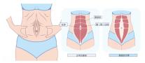腹直肌分离：产后妈妈的隐形挑战与科学应对